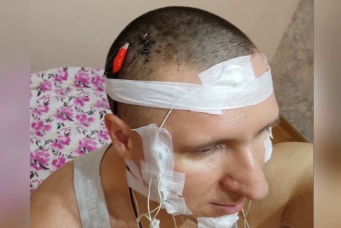 俄羅斯男子在家給自己做腦部植入芯片手術(shù)差點喪命