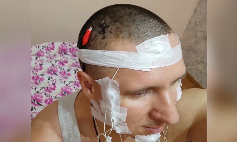 俄羅斯男子在家給自己做腦補(bǔ)植入芯片手術(shù)差點(diǎn)喪命
