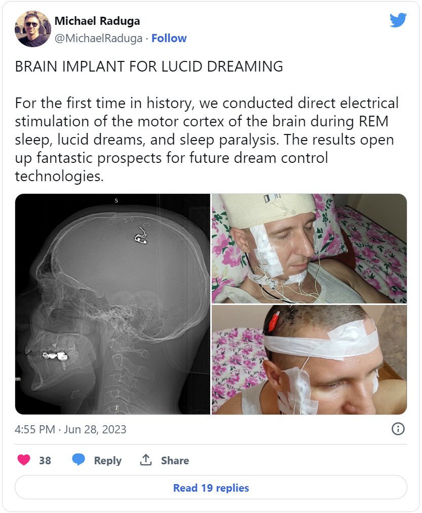 俄羅斯男子在家給自己做腦補(bǔ)植入芯片手術(shù)差點(diǎn)喪命