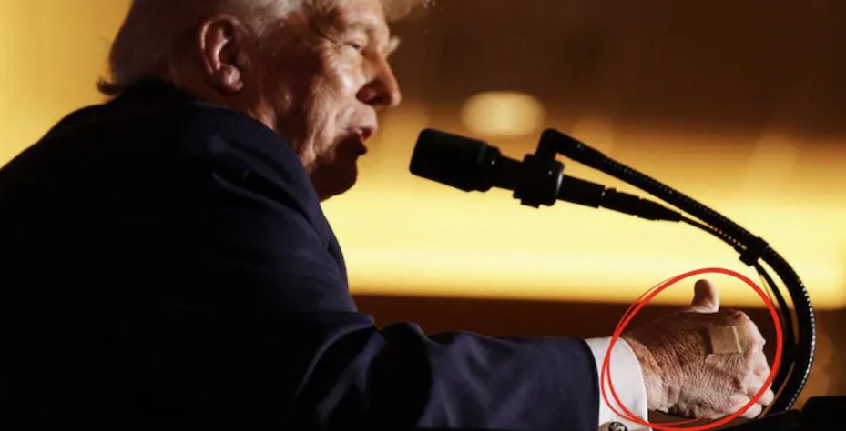 美國總統(tǒng)唐納德&middot;特朗普在一次活動中發(fā)表講話時，右手上貼著創(chuàng)口貼。